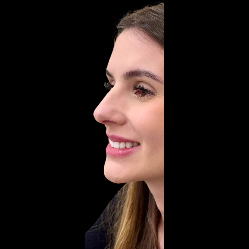 Nariz antes da rinoplastia