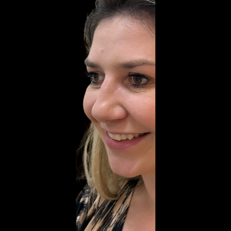Nariz antes da rinoplastia