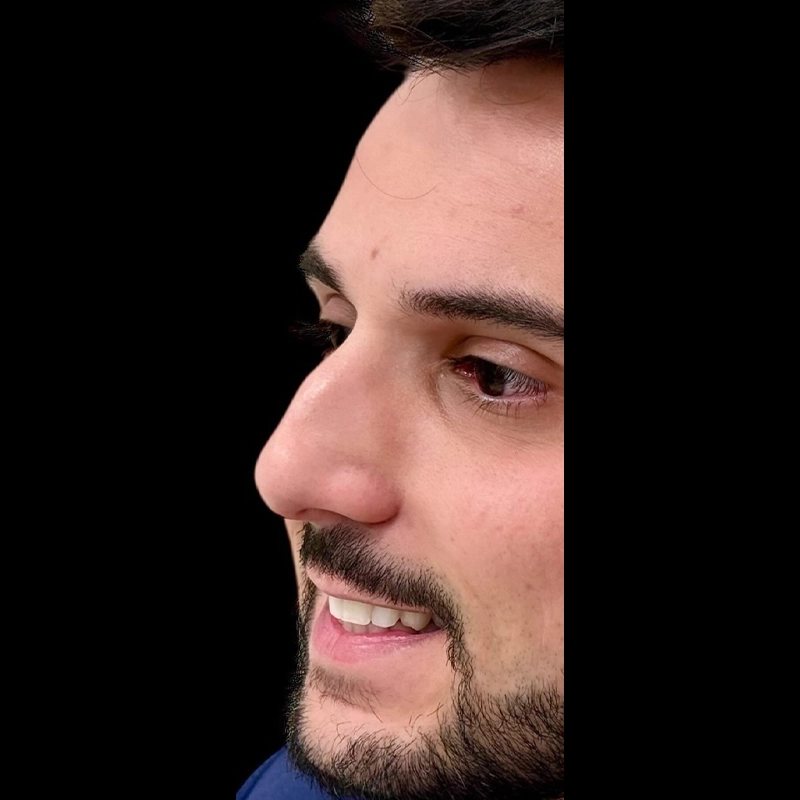 Nariz antes da rinoplastia