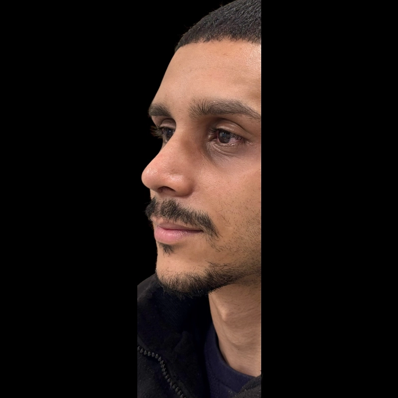 Resultado depois da rinoplastia