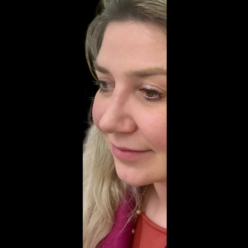 Resultado depois da rinoplastia