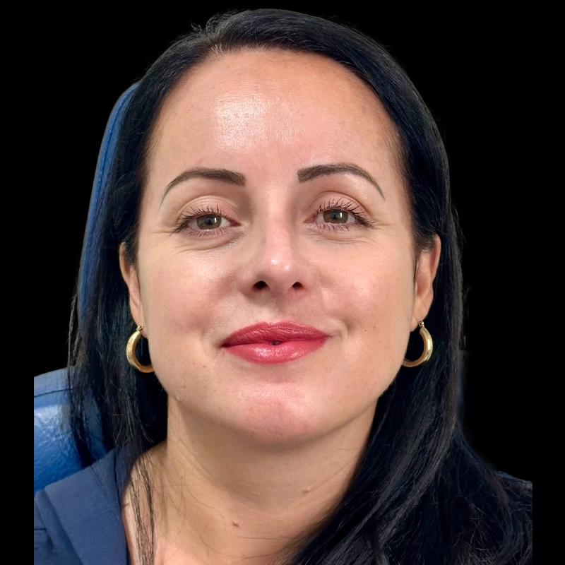 Resultado depois da rinoplastia